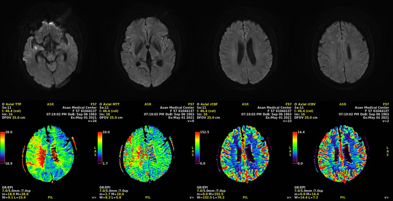 Diffusion & Perfusion MR