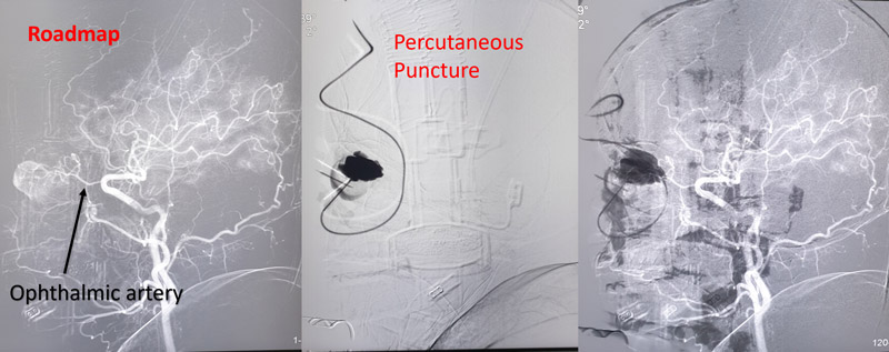 Direct Puncture Embolization