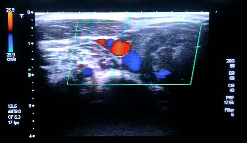Doppler D1 Post Embolization