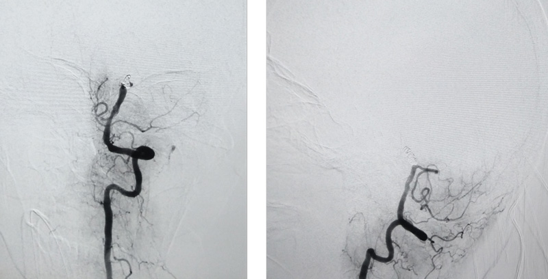 DSA from left vertebral artery