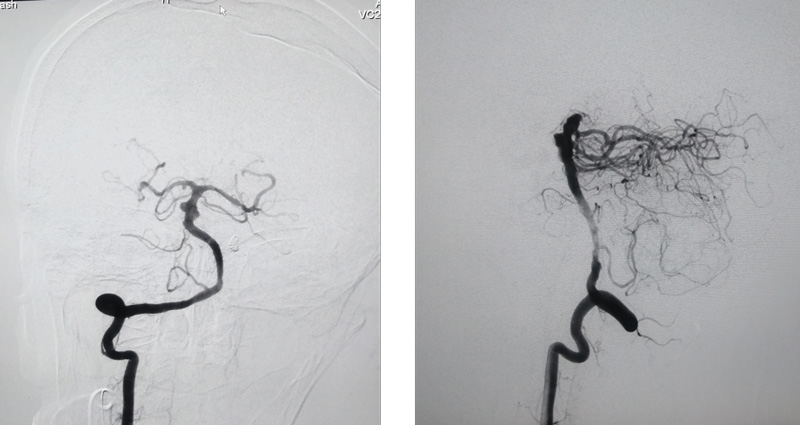 DSA from right vertebral artery