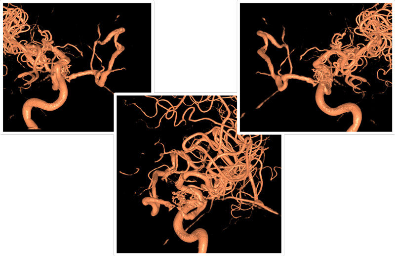 dural branches