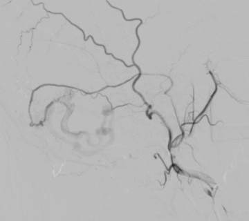 ECA and fistula from MMA