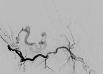 ECA with prominent fistula from occipital artery