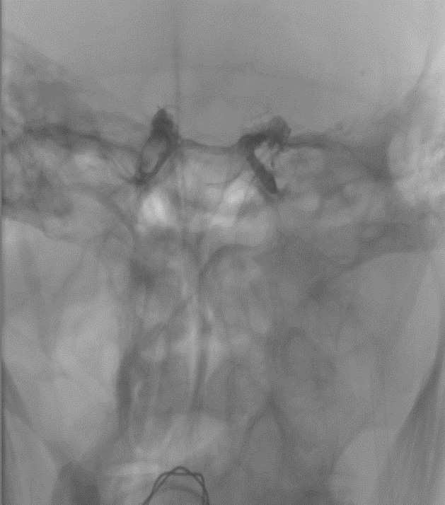 Embolization of right followed by left cavernous sinus fistulas