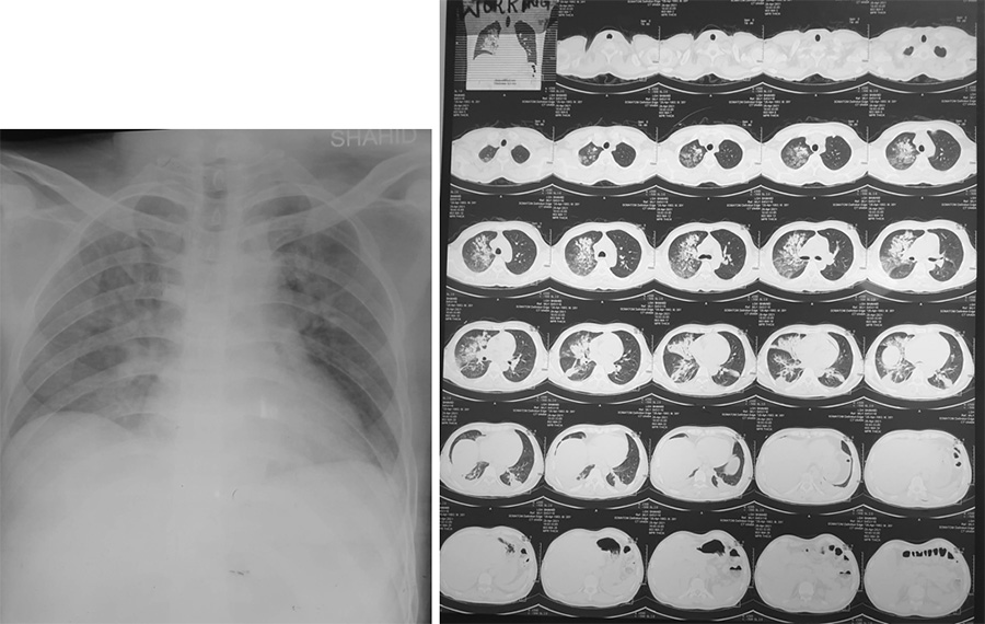 Endovascular Treatment of Pial AVM with Large Venous pouch in Covid-19 patient