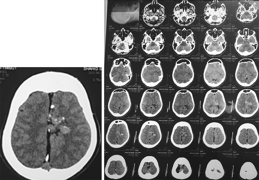 Endovascular Treatment of Pial AVM with Large Venous pouch in Covid-19 patient