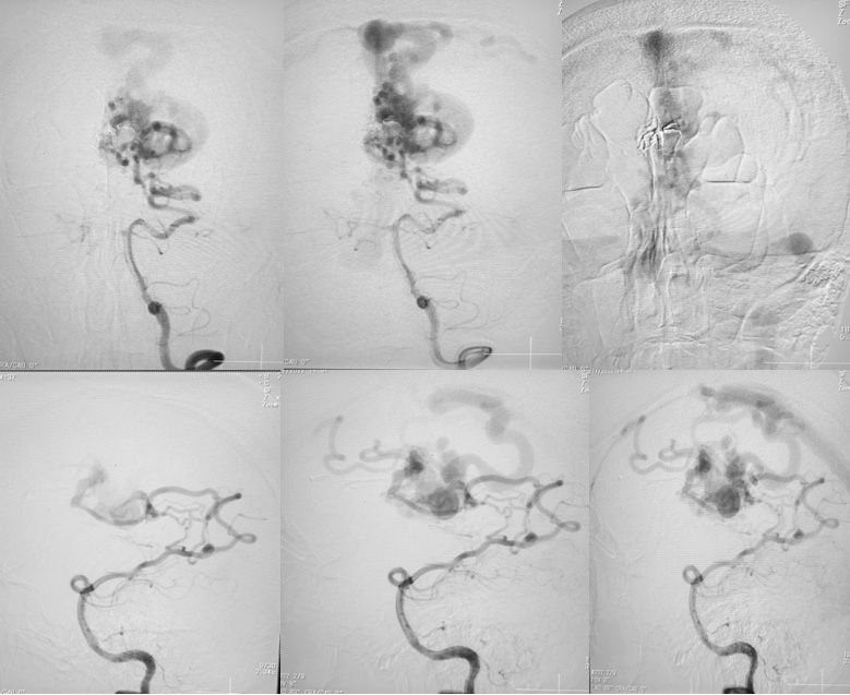 Endovascular Treatment of Pial AVM with Large Venous pouch in Covid-19 patient
