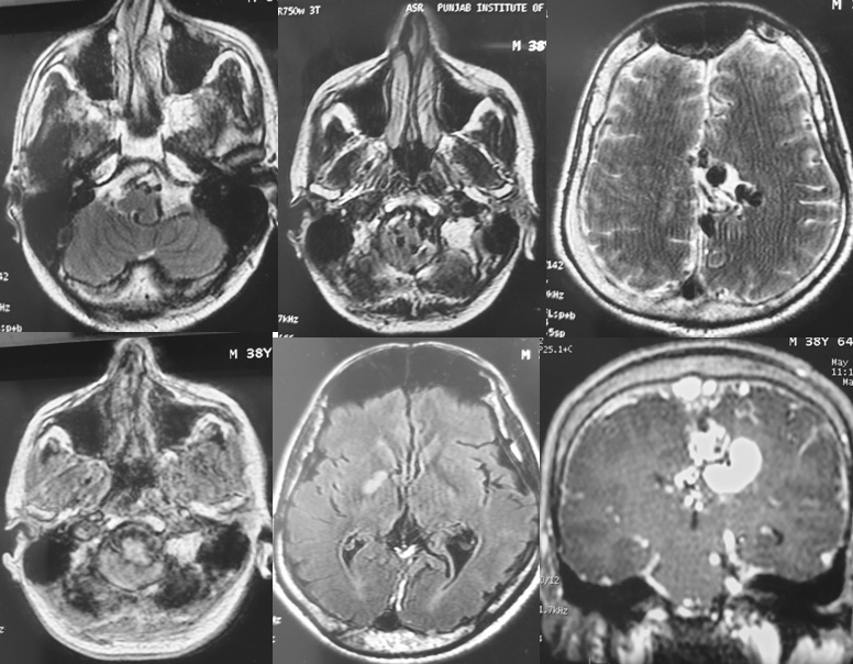 Endovascular Treatment of Pial AVM with Large Venous pouch in Covid-19 patient