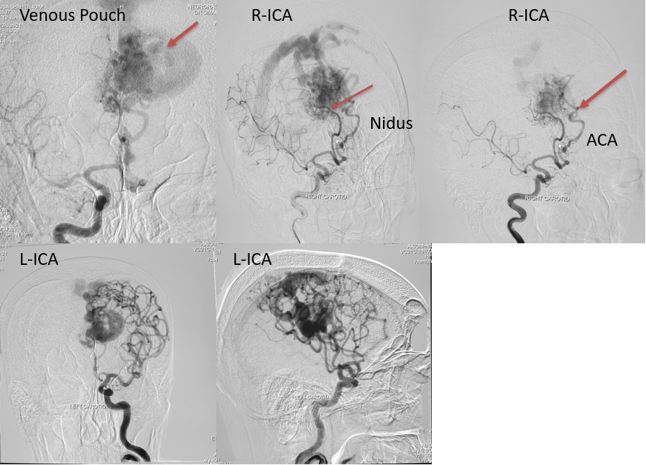 Endovascular Treatment of Pial AVM with Large Venous pouch in Covid-19 patient