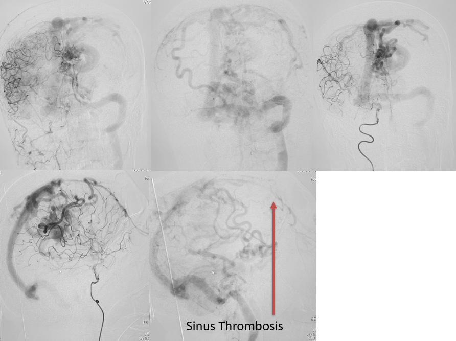 Endovascular Treatment of Pial AVM with Large Venous pouch in Covid-19 patient