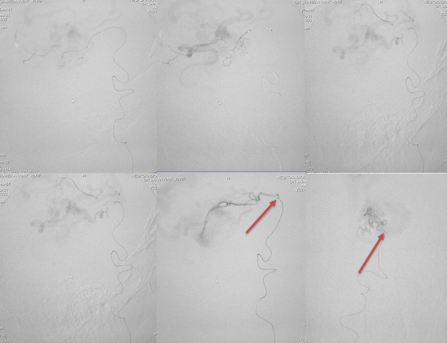 Endovascular Treatment of Pial AVM with Large Venous pouch in Covid-19 patient