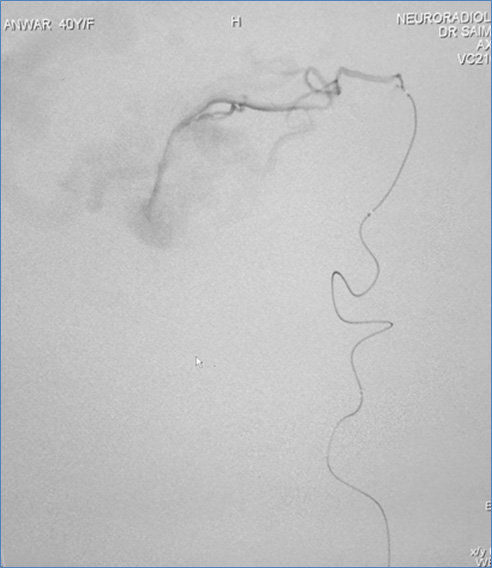 Endovascular Treatment of Pial AVM with Large Venous pouch in Covid-19 patient