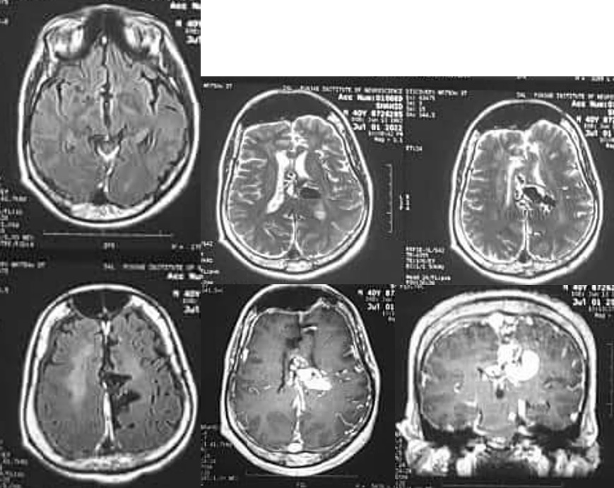 Endovascular Treatment of Pial AVM with Large Venous pouch in Covid-19 patient