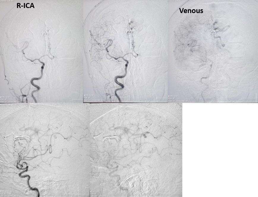 Endovascular Treatment of Pial AVM with Large Venous pouch in Covid-19 patient