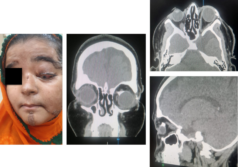 F/U CT at Discharge