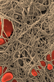 Fibrin/hard Clot