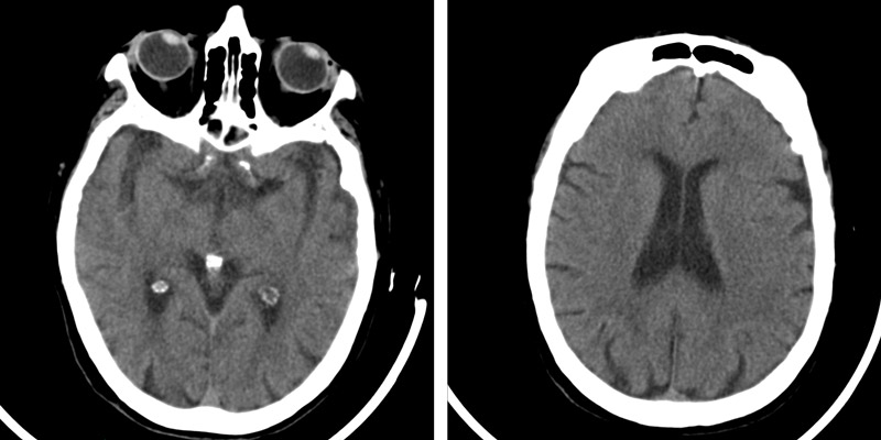 CT Brain with contrast 