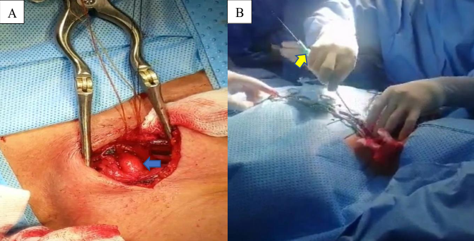 Sheath 8F introduced into common carotid artery