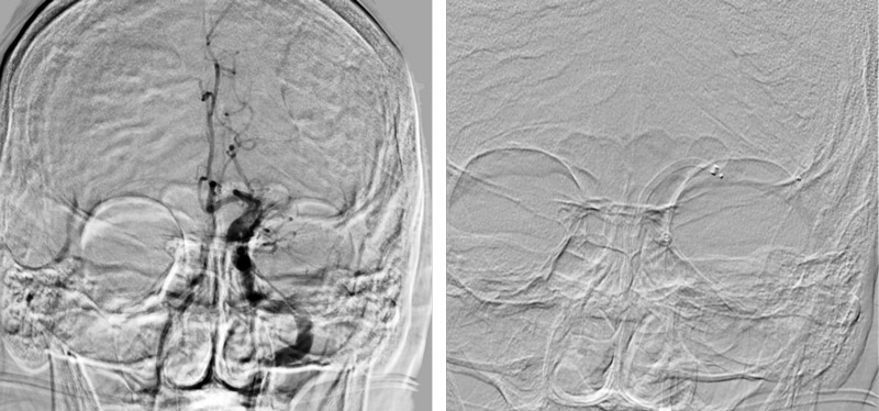 SOFIA 6Fr and Headway 21 using a synchro guidewire