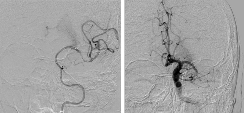 One pass thrombectomy with solitaire 4x40 mm