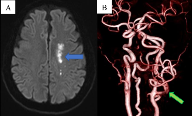 First cerebral MRI