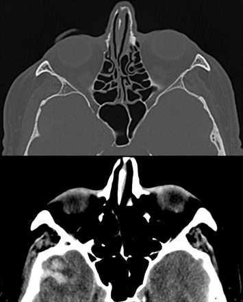 Right frontotemporal SAH and temporal intraparenchymal hemorrhage 