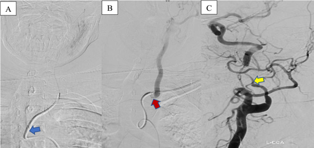 Figure 2: First endovascular therapy