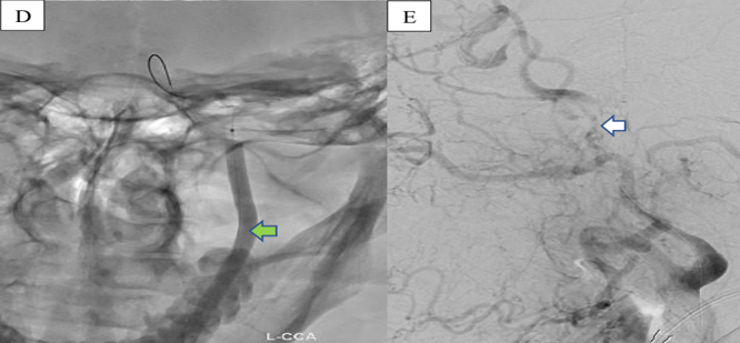 Figure 3: Angioplasty and Restenosis
