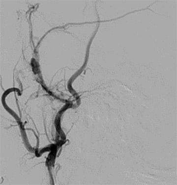 second pseudoaneurysm in the left MMA.
