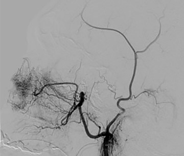 Endovascular embolization was performed of the second pseudoaneurysm