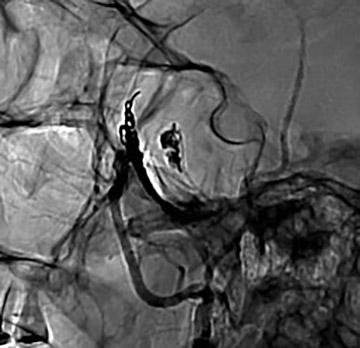 MMA traumatic pseudoaneurysms associated with head trauma