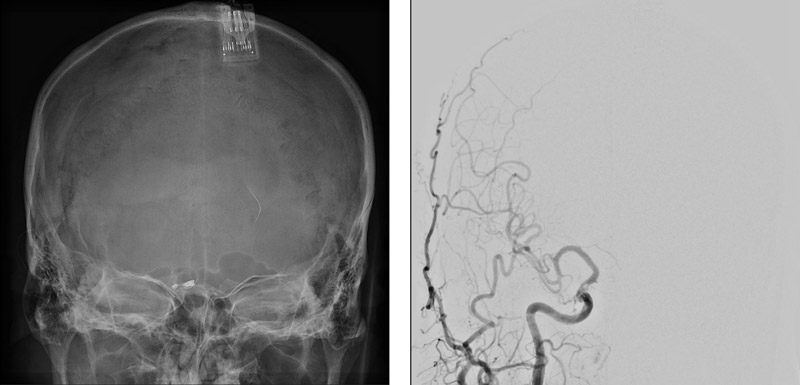 Final control angiography confirmed complete occlusion of the shunt