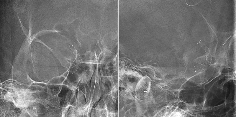 Flow diverter placement