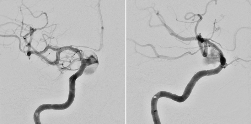 Flow diverter placement