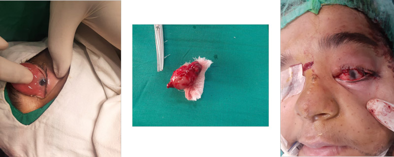 Followed by total excision next consecutive day / 70 ml intraoperative blood loss