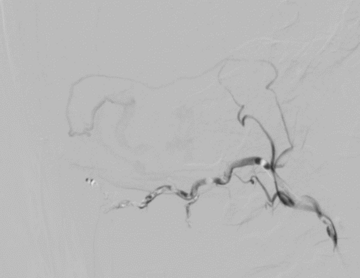 Glue injection, occipital artery