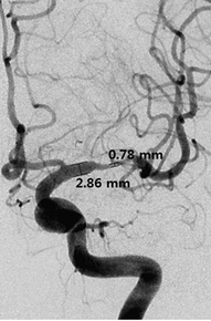 ICAD with acute occlusion