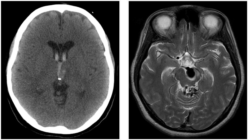 Interpeduncular fossa Aneurysm AVM at cerebellar vermis