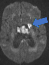 Ischemic stroke