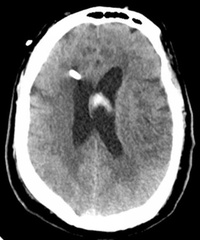 Ischemic stroke