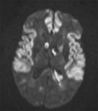 Ischemic stroke