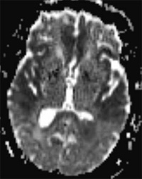 Ischemic stroke