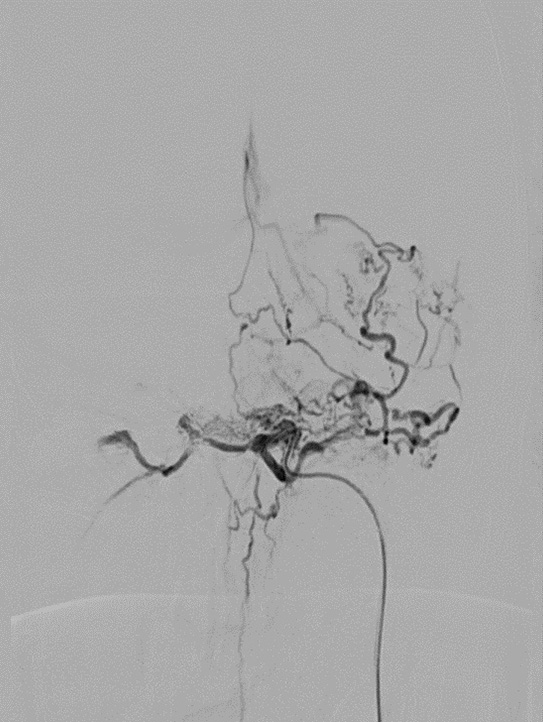 Left IPS cannulation