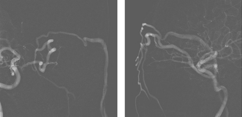 Left middle temporal vein