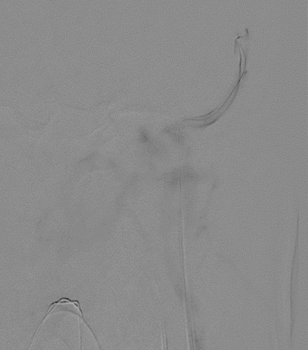 Left sigmoid sinus microcatheter injection  
