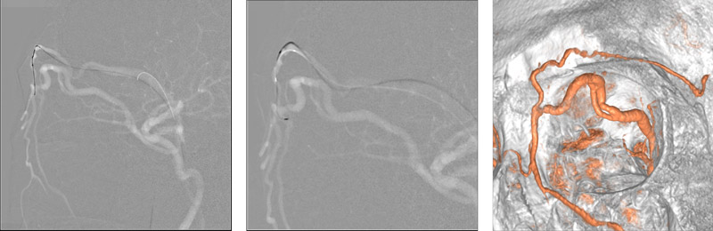 Left supraorbital vein