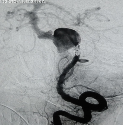 Left vertebral artery occluded by coiling