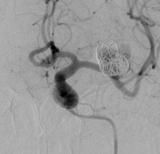 M1 left aneurysm