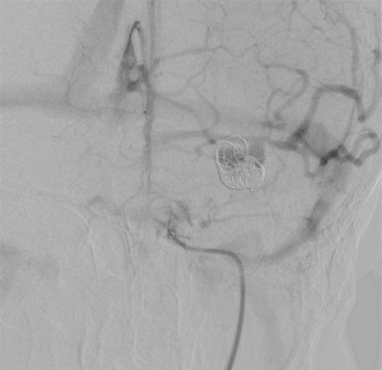 M1 left aneurysm
